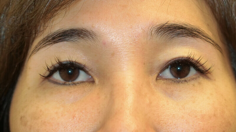 Asian Eyelid Surgery - After