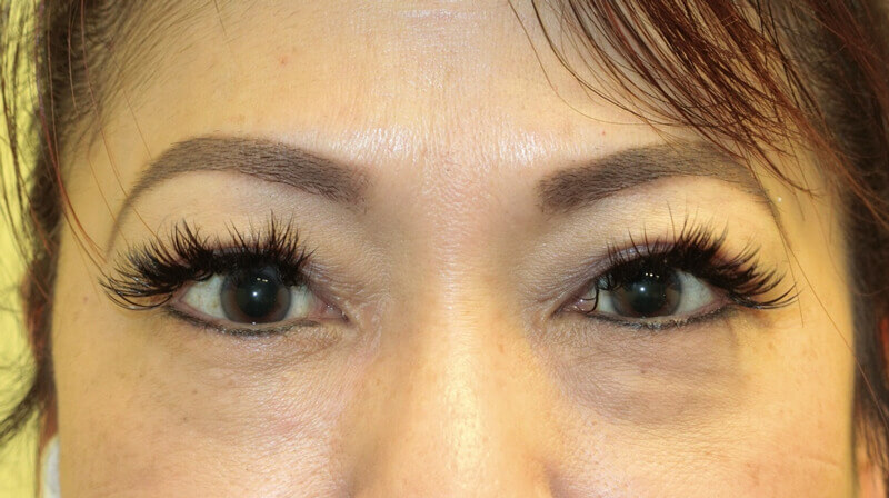 Asian Eyelid Surgery - After