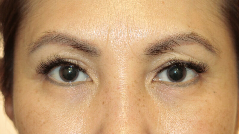 Asian Eyelid Surgery - After