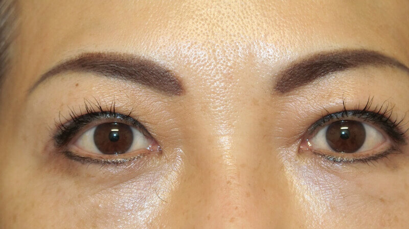 Asian Eyelid Surgery - After