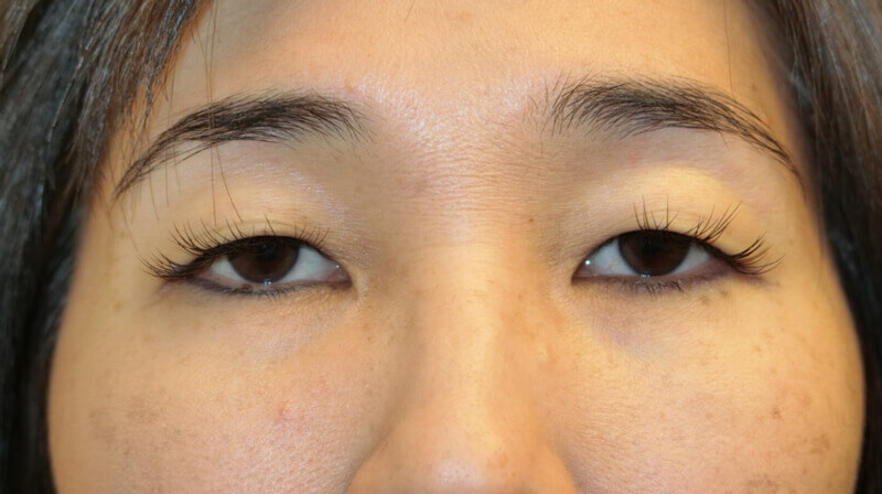 Asian Eyelid Surgery - Before