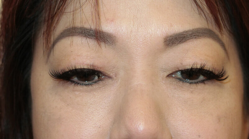 Asian Eyelid Surgery - Before