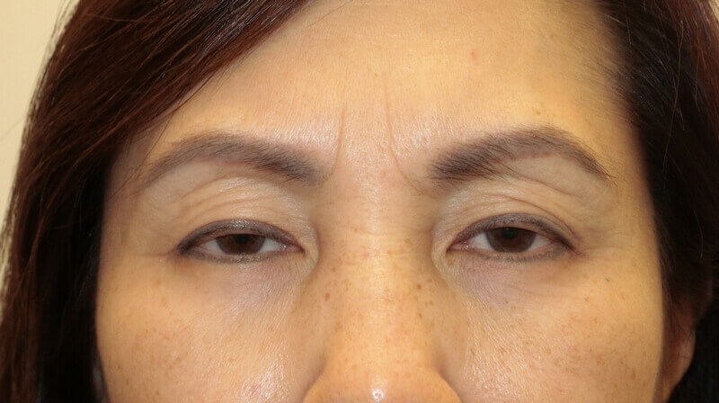 Asian Eyelid Surgery - Before