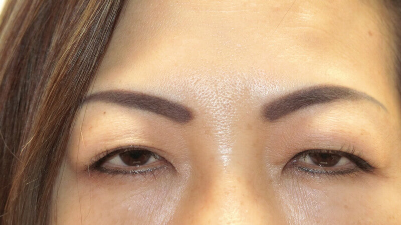 Asian Eyelid Surgery - Before