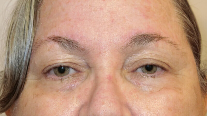 Following browlift, but still with upper eyelid ptosis