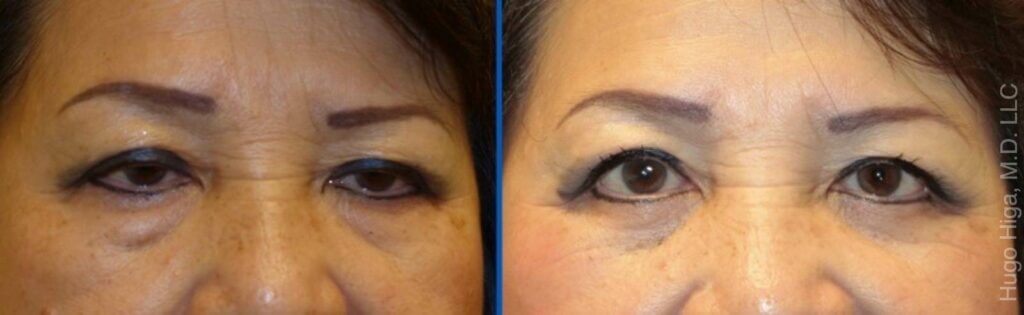 Chinese Woman Bilateral Upper Eyelid Ptosis Repair and Blepharoplasty