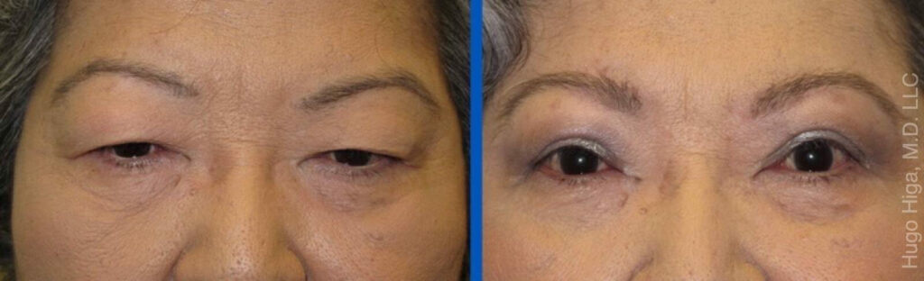 Chinese woman Bilateral upper eyelid blepharoplasty