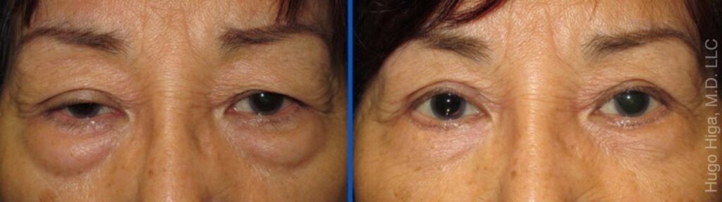 Filipina Woman Bilateral Upper Eyelid Ptosis Repair, Upper and Lower Blepharoplasty