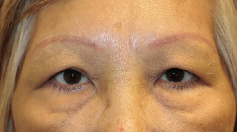 Indirect Eyebrow Lift Before