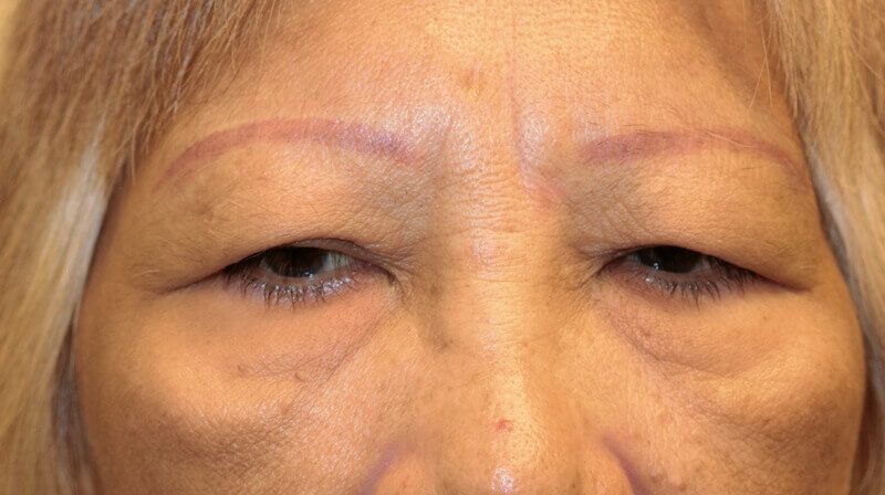 Indirect Eyebrow Lift Before