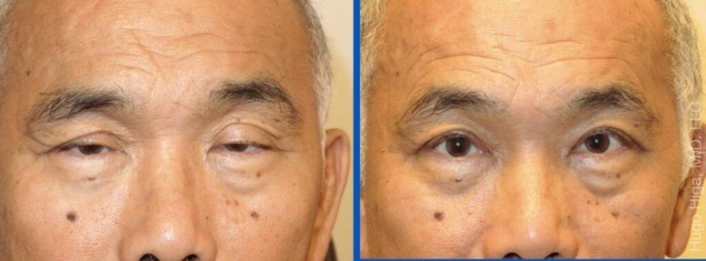 Japanese Man Bilateral Upper Eyelid Ptosis Repair and Browlift