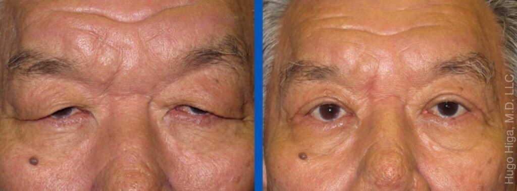 Japanese Man Bilateral Upper Eyelid Ptosis Repair and Blepharoplasty