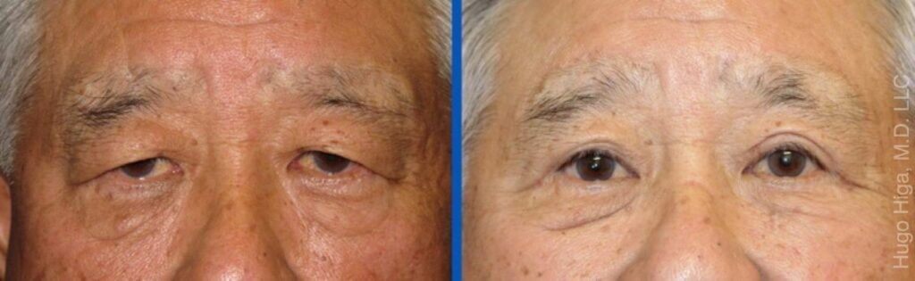 Japanese Man Bilateral Upper Eyelid Ptosis Repair and Blepharoplasty