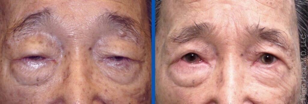 Japanese Man Bilateral Upper Eyelid Ptosis Repair and Blepharoplasty