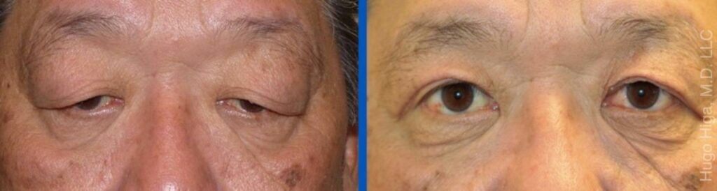 Japanese Man Bilateral Upper Eyelid Ptosis Repair and Blepharoplasty