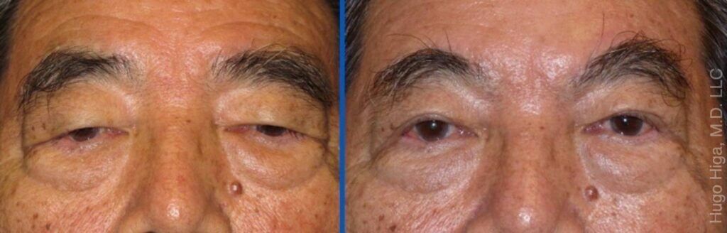 Japanese Man Bilateral Upper Eyelid Ptosis Repair and Browlift