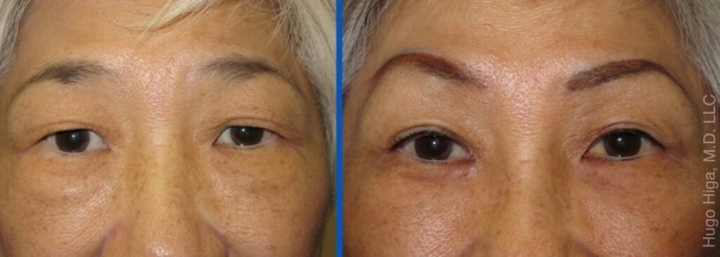 Japanese Woman Bilateral Upper Eyelid Ptosis Repair