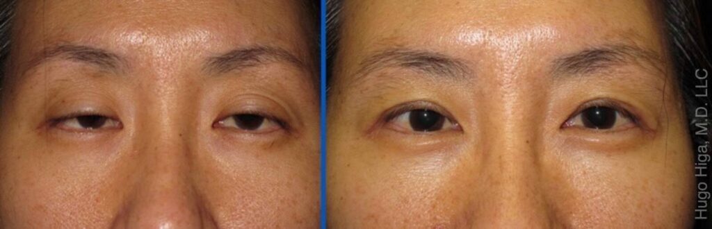 Japanese Woman Bilateral Upper Eyelid Ptosis Repair