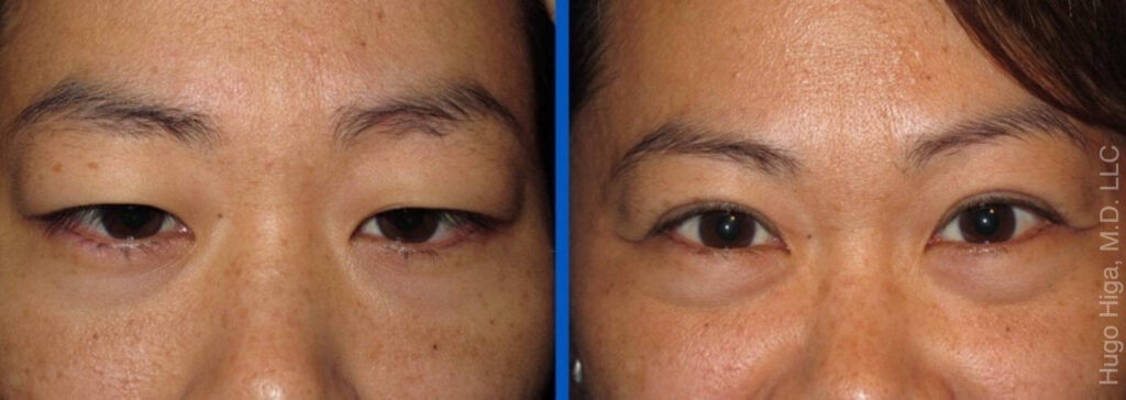 Japanese Woman Bilateral Upper Eyelid Ptosis Repair and Blepharoplasty