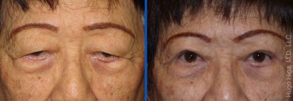 Japanese Woman Bilateral Upper Eyelid Ptosis Repair and Blepharoplasty