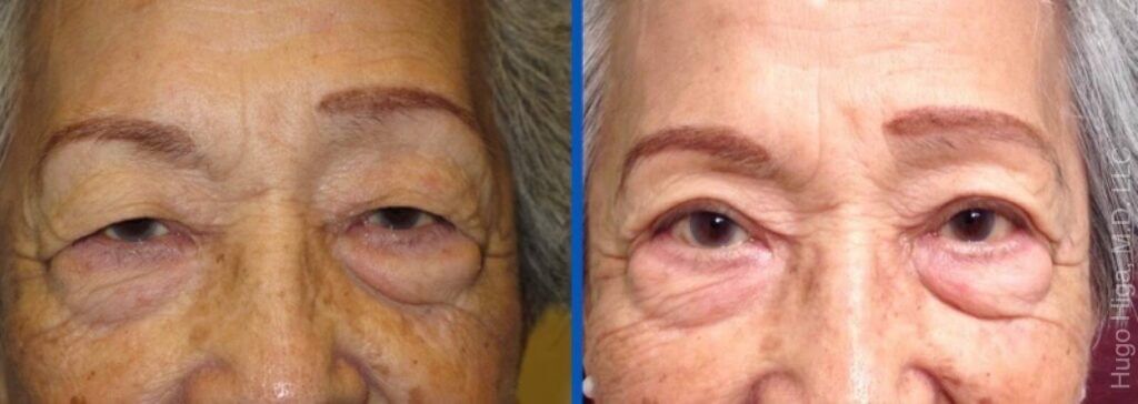 Japanese Woman Bilateral Upper Eyelid Ptosis Repair and Blepharoplasty