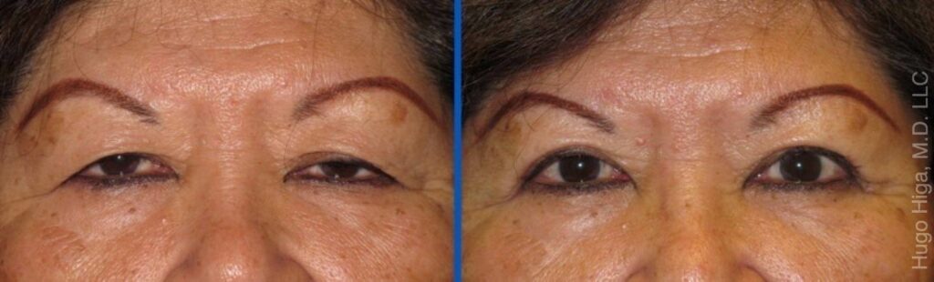 Japanese Woman Bilateral Upper Eyelid Ptosis Repair and Blepharoplasty