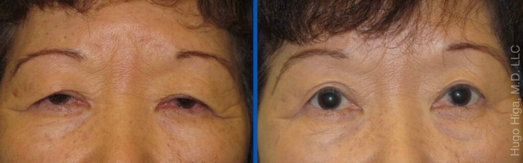 Japanese Woman Bilateral Upper Eyelid Ptosis Repair and Blepharoplasty