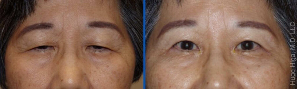 Japanese Woman Bilateral Upper Eyelid Ptosis Repair and Blepharoplasty