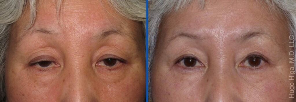 Japanese Woman Bilateral Upper Eyelid Ptosis Repair and Blepharoplasty