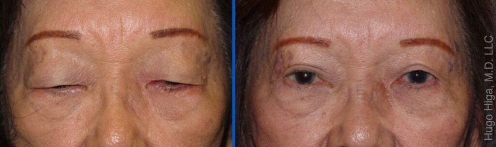 Japanese Woman Bilateral Upper Eyelid Ptosis Repair and Blepharoplasty