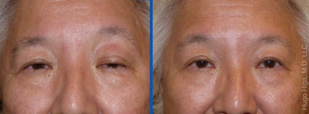 Japanese Woman Left Upper Eyelid Ptosis Repair