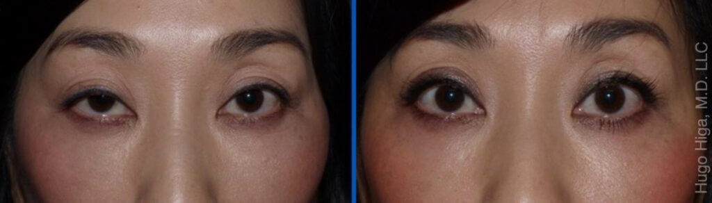 Japanese Woman Right Upper Eyelid Ptosis Repair