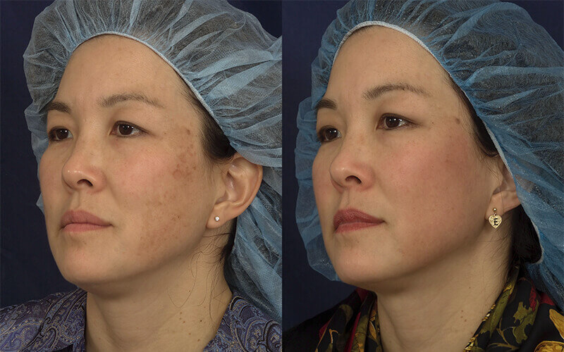 Fractionated Laser Before and After