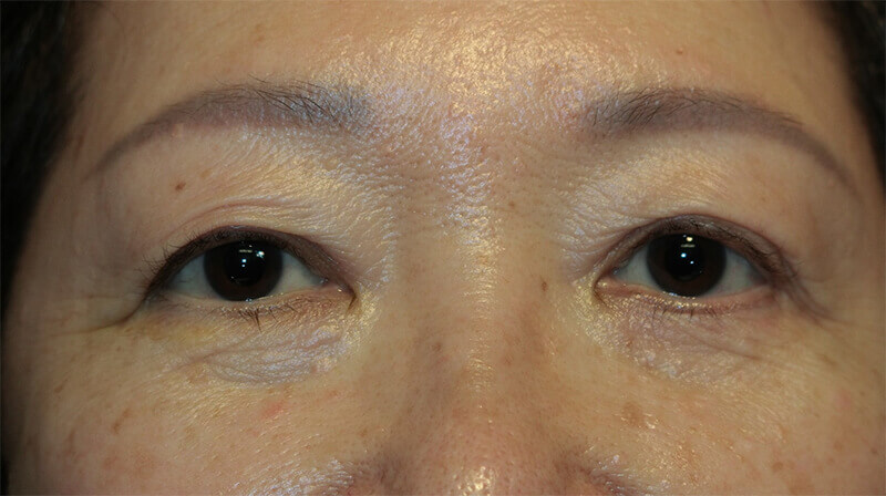 Lower Eyelid Blepharoplasty After