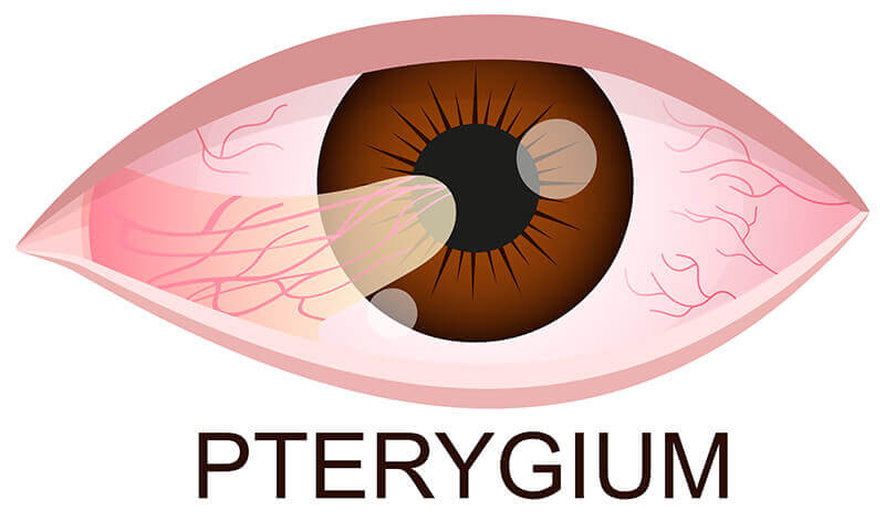 Pterygium Diagram