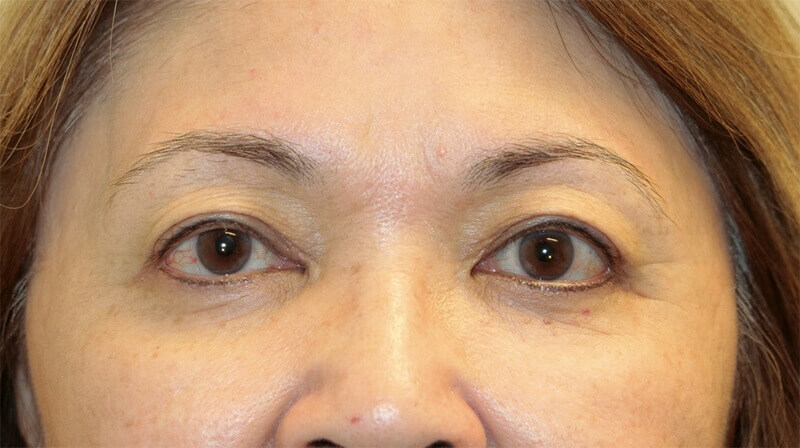 Ptosis Surgery After