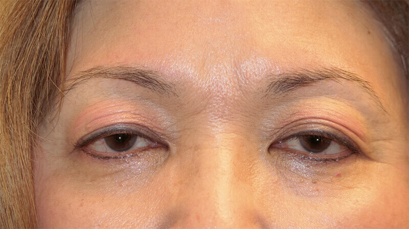 Ptosis Surgery Before