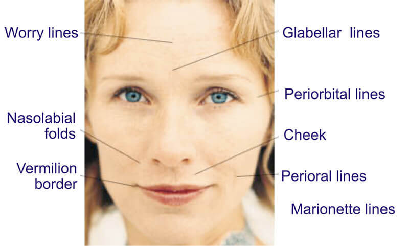 Diagram of the types of facial wrinkles