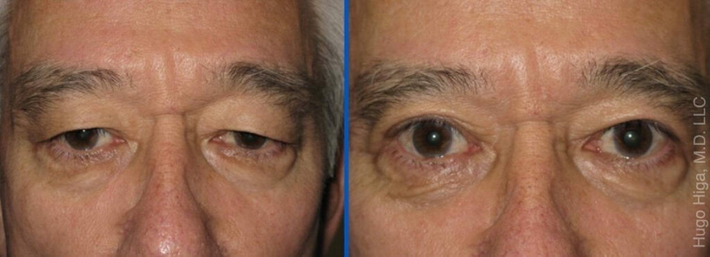 White Man Bilateral Upper Eyelid Ptosis Repair and Blepharoplasty