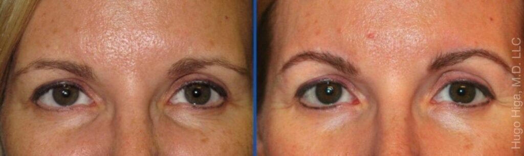 White Woman Bilateral Browlift