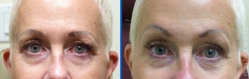 White Woman Bilateral Browlift