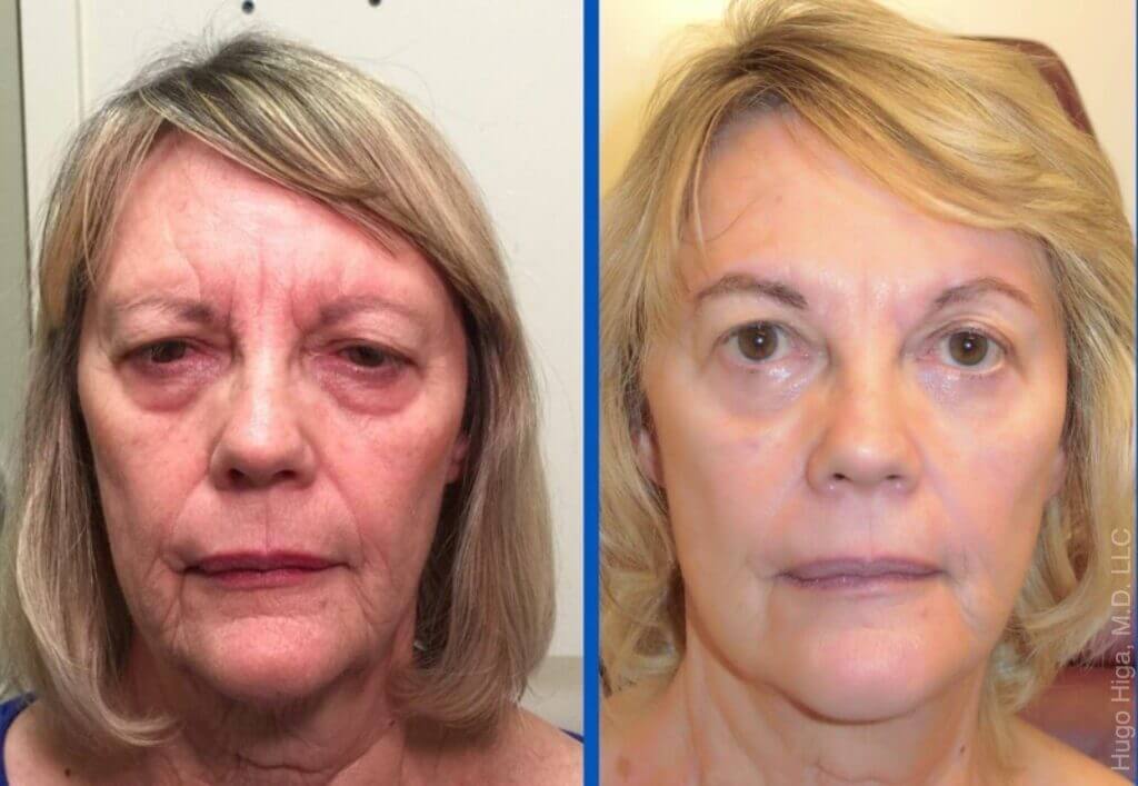 White Woman Facelift, Bilateral Browlift, and Bilateral Lower Eyelid Blepharoplasty