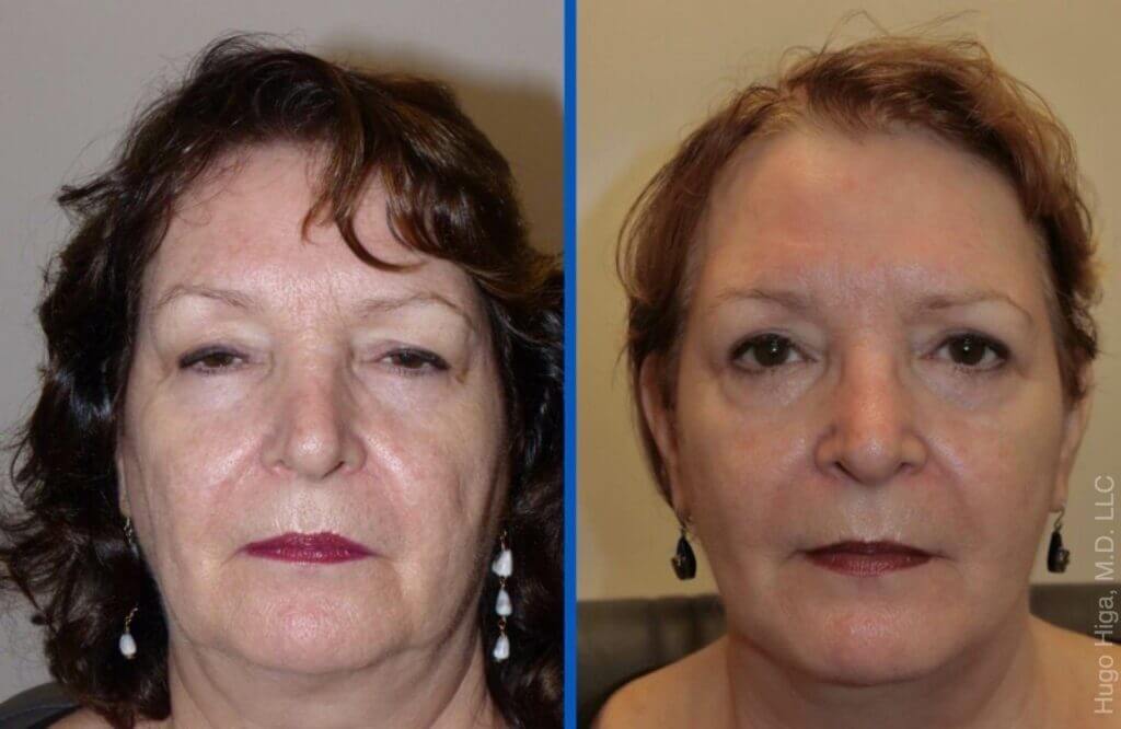White Woman Facelift, Bilateral Upper and Lower Eyelid Blepharoplasty