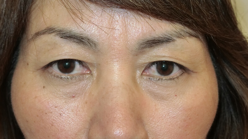 Asian Eyelids