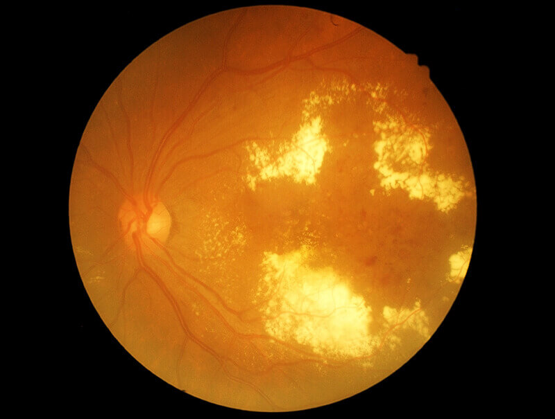 Diabetic Retinopathy