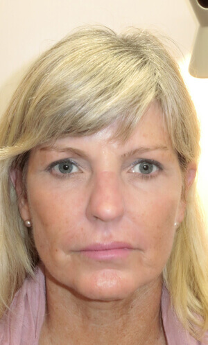 Woman after facelift