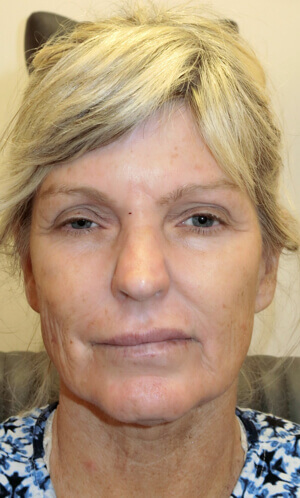 Woman before facelift