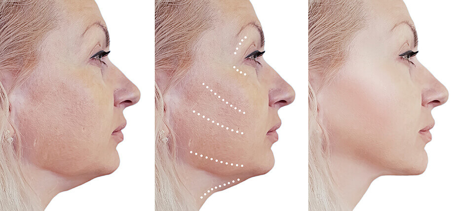 Facelift Steps Profile