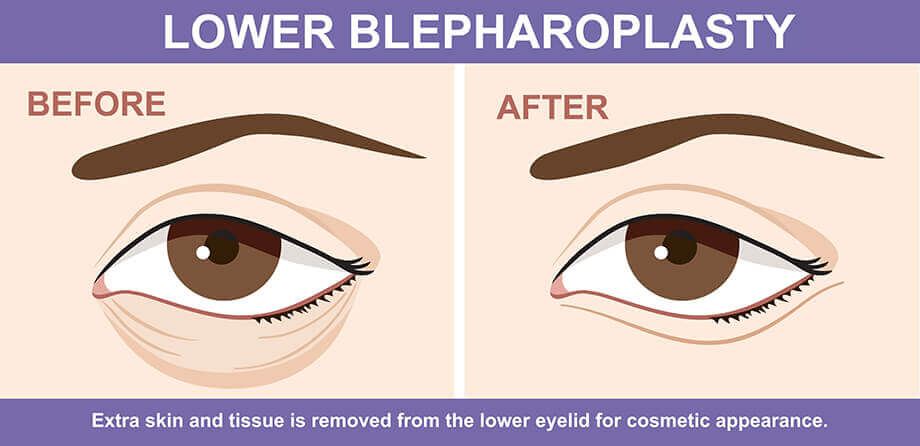 Lower Blepharoplasty