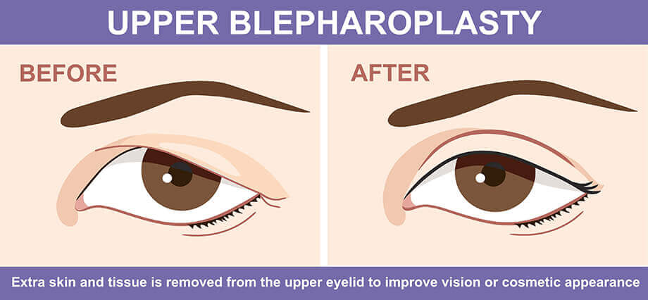 Upper blepharoplasty diagram